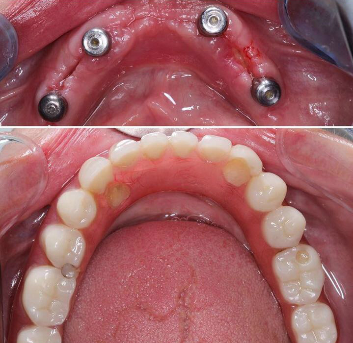 имплантация при отсутствии зубов