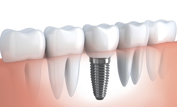 имплантология зубов