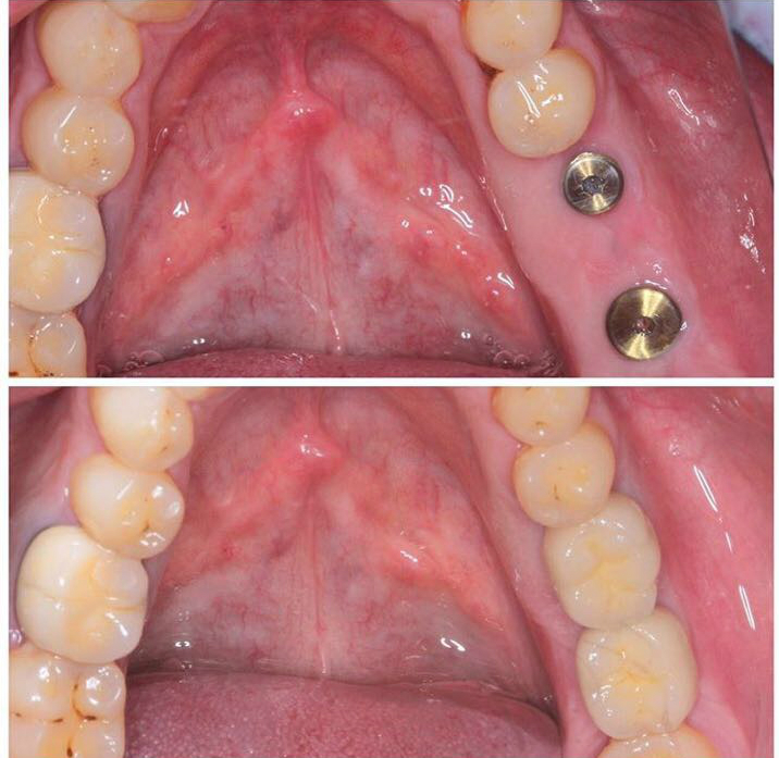 Когда можно ставить имплант после удаления зуба