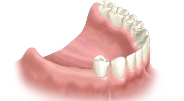 концевой дефект зубного ряда