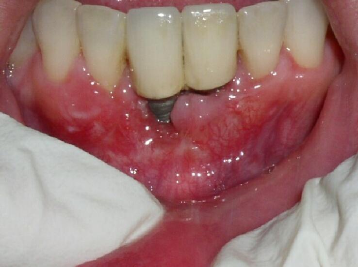 основные признаки и причины отторжения зубного импланта