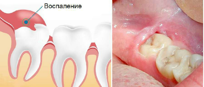 Заживление лунки после удаления зуба - этапы, возможные осложнения, уход