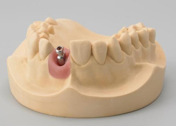 Трансферы в стоматологии